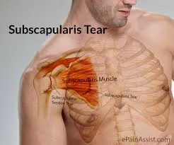 What Is Subscapularis Tendinitis?