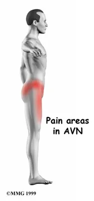 Avascular Necrosis of the Hip Symptoms