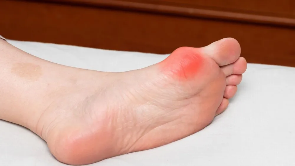 Hallux Rigidus Hallux Rigidus