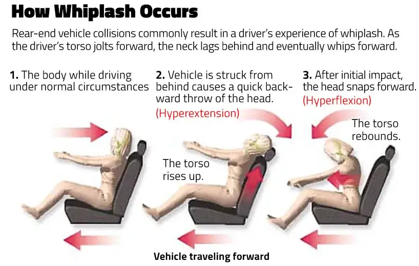 How whiplash occurs