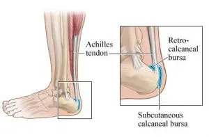 Retrocalcaneal bursitis 300x197 1