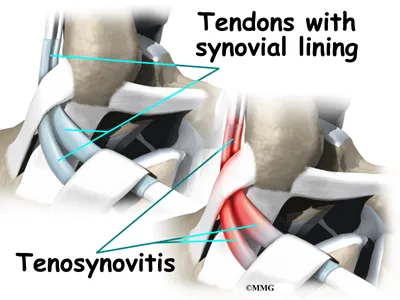 Ankle Peroneal Tendon Causes
