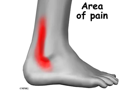 Ankle Peroneal Tendon Symptoms