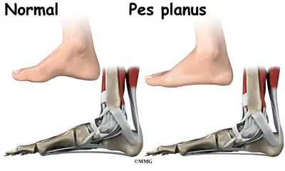child flatfoot causes01
