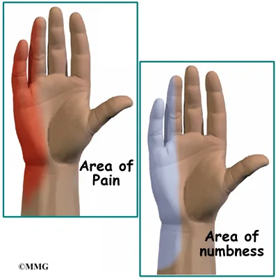 Elbow Cubital Tunnel Syndrome Symptoms