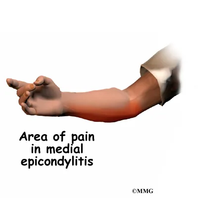 elbow medepi symptom01 elbow medepi symptom01