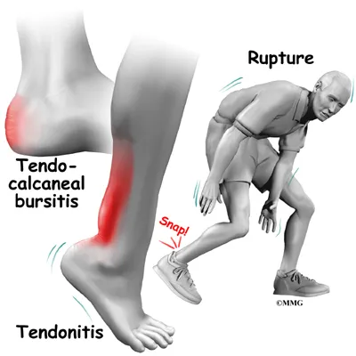 Types of Achilles Tendon Problems