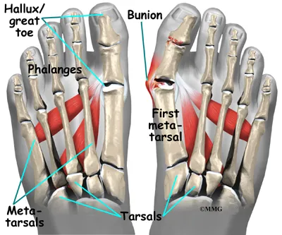 foot bunion anat01