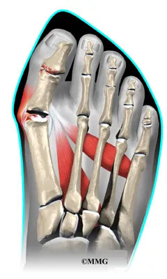 foot bunion causes01