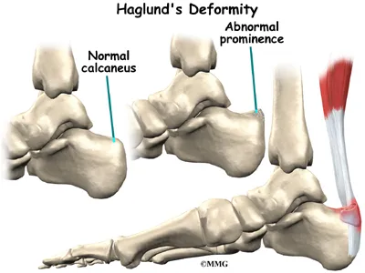 foot haglunds causes01