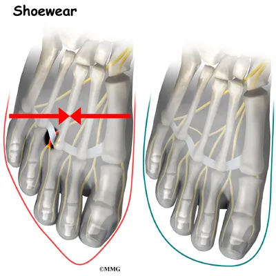 foot neuroma causes01