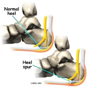 foot plantar fasciitis2 300x300 1