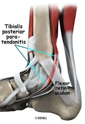 Foot Posterior Tibial Tendon Problems Causes