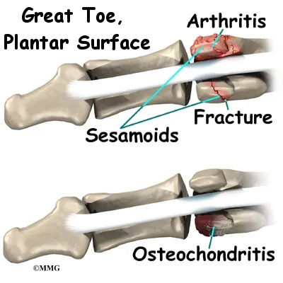 foot sesamoiditis causes01