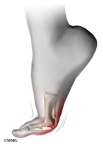 foot sesamoiditis symptoms01