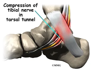 Foot Tarsal Tunnel Syndrome Causes