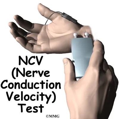 hand carpal tunnel diagnosis01