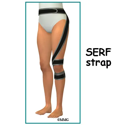 hip labral tear SERF strap