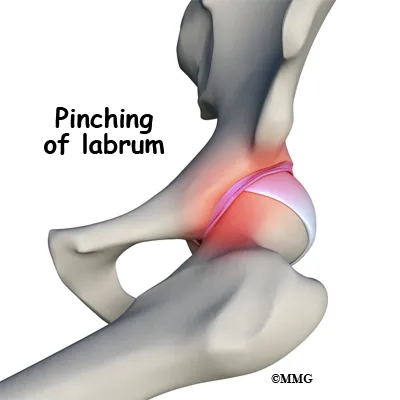 hip labral tear pinching