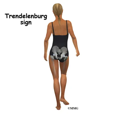 hip_labral_tear_trendelenburg
