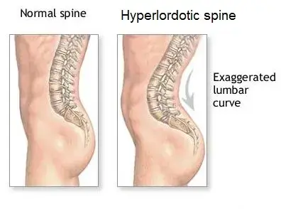 hyperlordosis 1