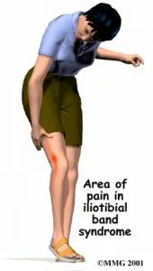 ITB Syndrome Symptoms