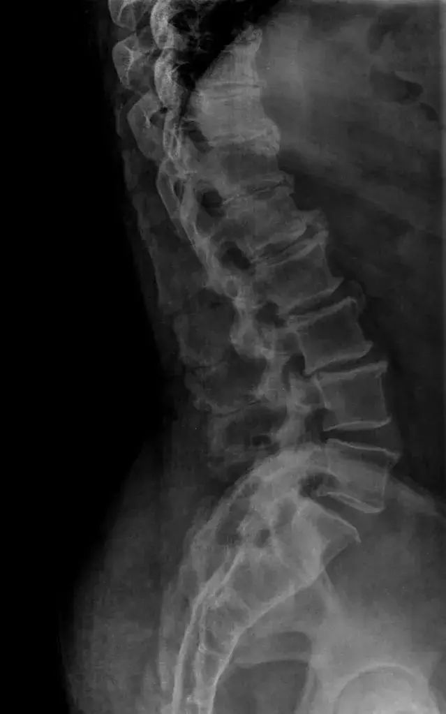 kissing Kissing Xray