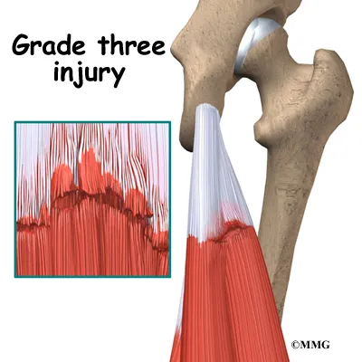 knee hamstring diagnosis03