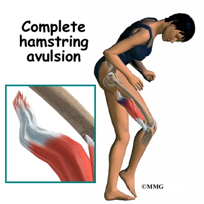 knee hamstring symptom01
