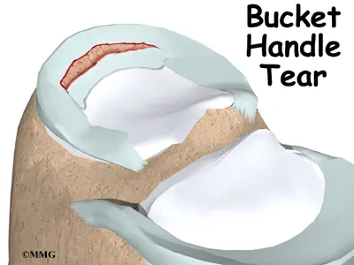 knee meniscus cause01