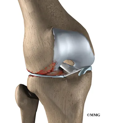 Meniscal Injuries Symptoms