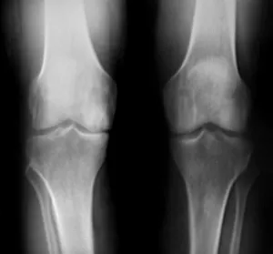 knee osteoarth diagnosis02