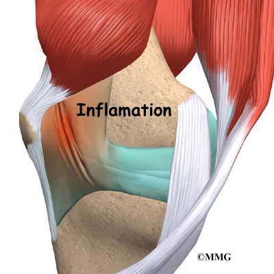 Plica Syndrome Causes