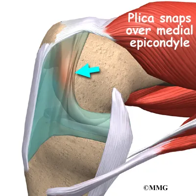 Plica Syndrome Symptoms