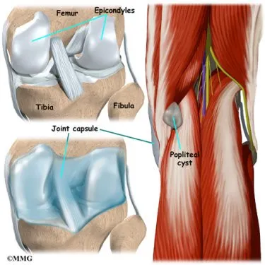 knee popcyst cause01