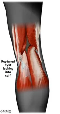 Popliteal Cysts Diagnosis