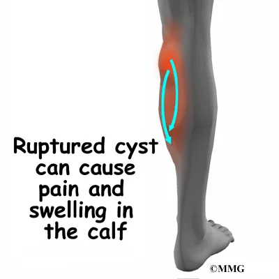 knee popcyst symptoms01