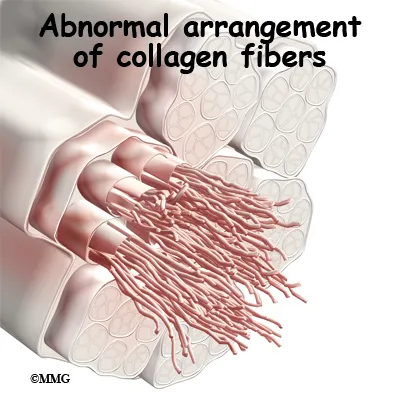 knee tendonitis quadriceps abnormal collagen