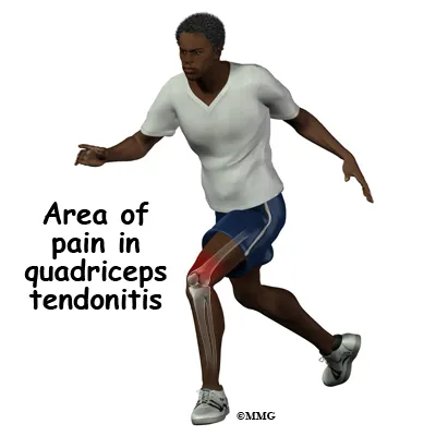 knee tendonitis quadriceps symptom01