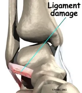 lat ankle sprain 265x300 1