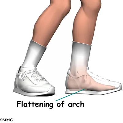 leg shinsplints cause01