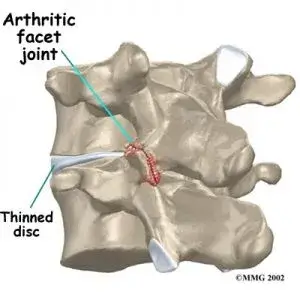 low back pain 300x300 1