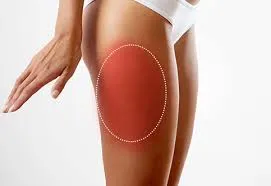 Meralgia Parasthetica Causes