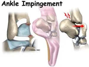 Ankle Impingement Anatomy