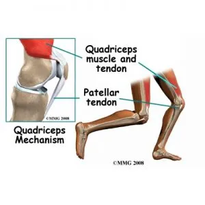 patellar tendonitis 300x300 1