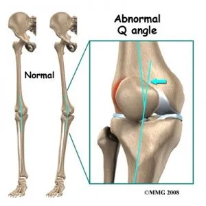 Causes of Patellar Tendonitis