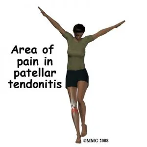 patellar3 300x300 1