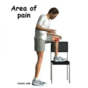 Pes Anserine Bursitis Symptoms