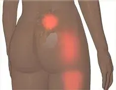 sacroiliitis e1551528000987 sacroiliitis e1551528000987