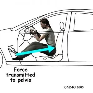 sciatica osteopath 300x300 1 Sciatica, Osteopath